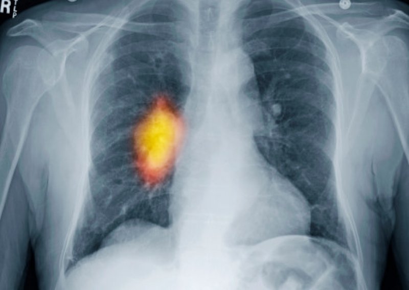 Promjene u genima mogu povećati rizik od bolesti pluća