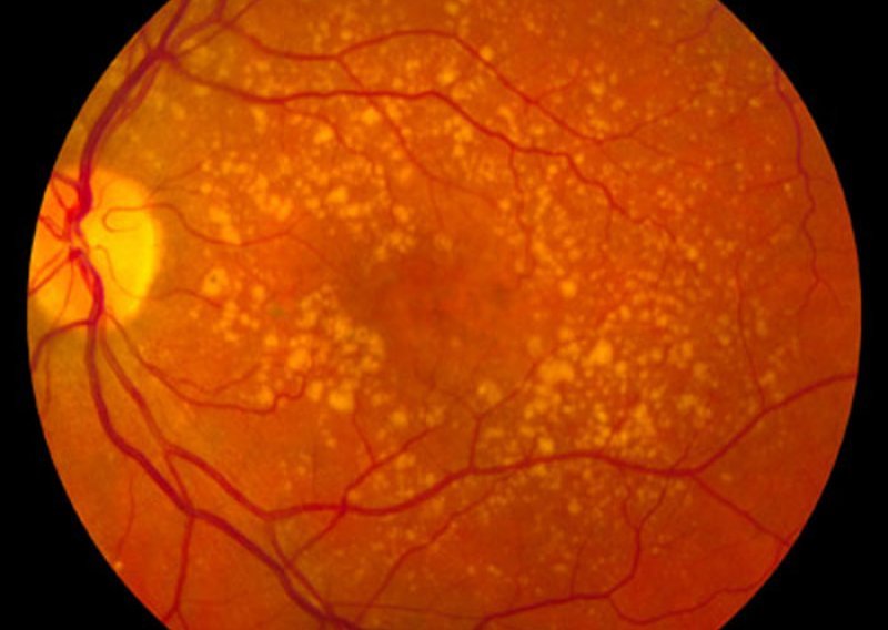 Matičnim stanicama vraćen vid slijepima